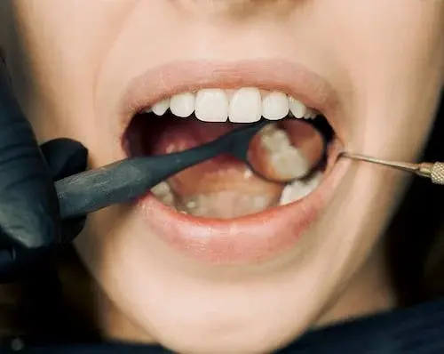 Close-up of an open mouth during a scaling, with instruments at the lower front teeth.